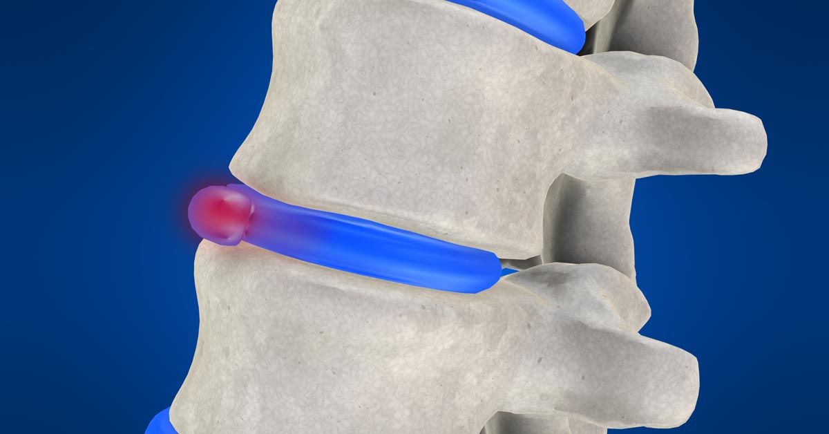 Prescott non-surgical disc herniation treatment