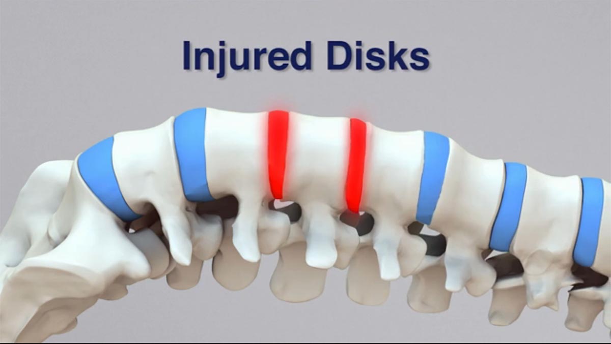 Prescott non-surgical spinal decompression